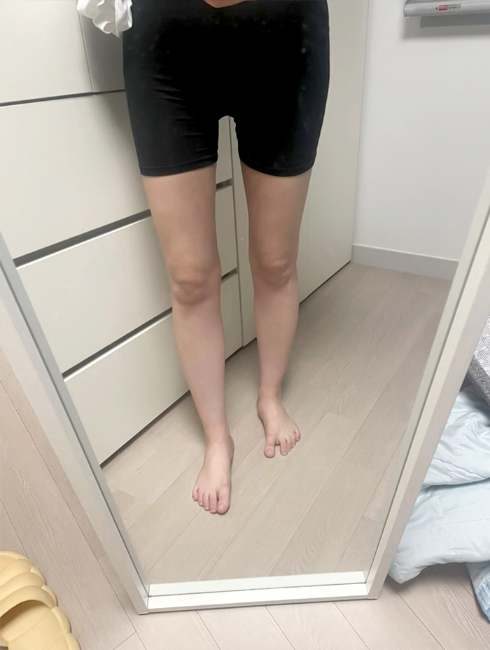 Front view of bang2bong’s slimmer thighs 3 months after liposuction at Lesarts.