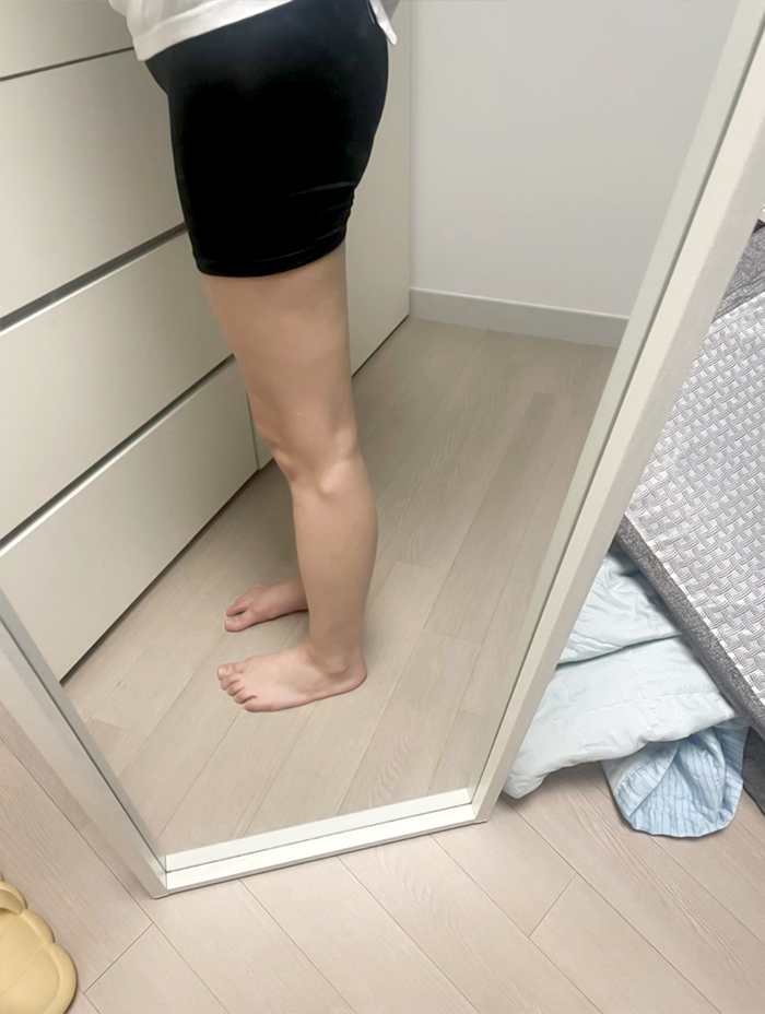 Side view of bang2bong’s legs after thigh liposuction, showing improved silhouette.