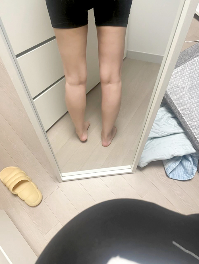 Side view of bang2bong’s legs after thigh liposuction, showing improved silhouette.