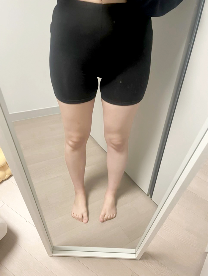 bang2bong's legs before thigh liposuction at Lesarts Plastic Surgery, showing inner and outer thigh bulk.