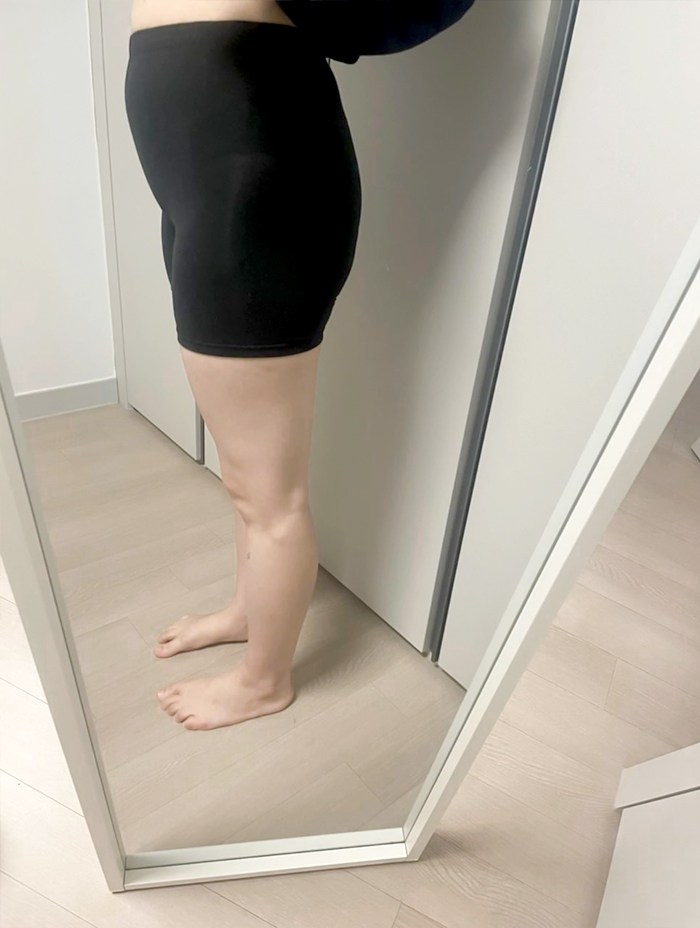 bang2bong's legs before thigh liposuction at Lesarts Plastic Surgery, showing inner and outer thigh bulk.