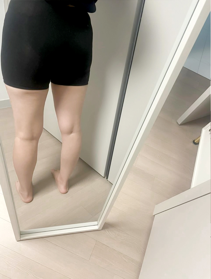 Side and back view of bang2bong's thighs before fat removal at Lesarts in Korea.