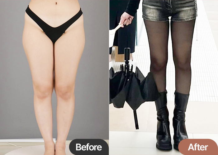 Side-by-side comparison of Katachipa's thigh liposuction shows dramatic leg slimming.