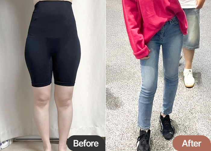 Before and after thigh liposuction results in Korea by pomingppueng
