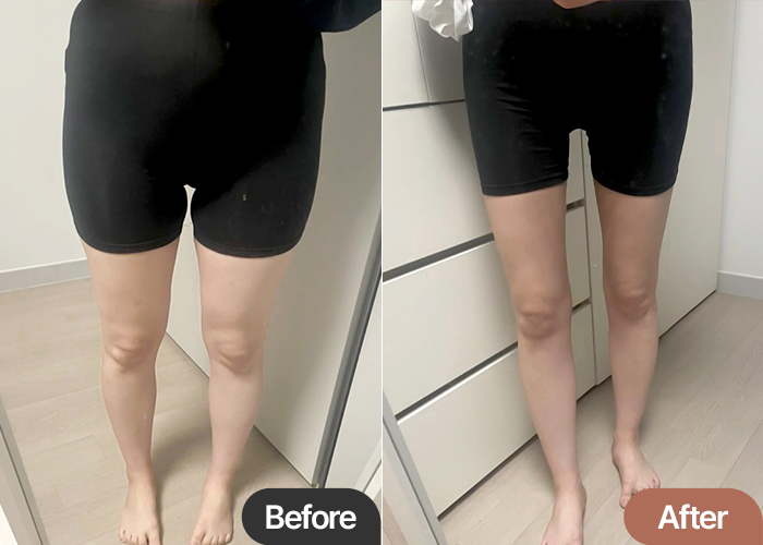 Before and after comparison of bang2bong’s thigh liposuction results at Lesarts Plastic Surgery in Korea.