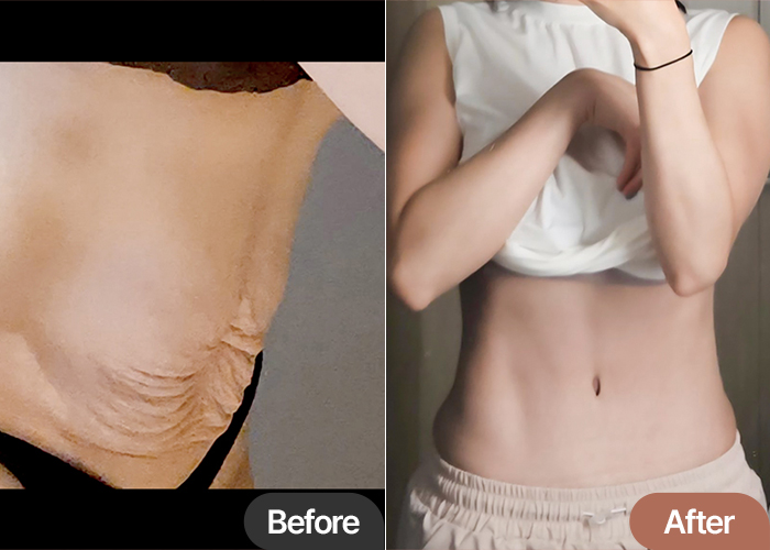 Comparison of sagging skin before and toned abdominal shape after tummy tuck in Korea.