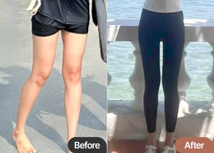 vvv22’s side-by-side before and after of inner thigh liposuction at Lesarts in Korea