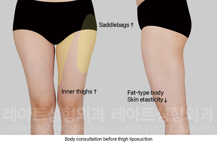 thigh_liposuction_02_01_250227