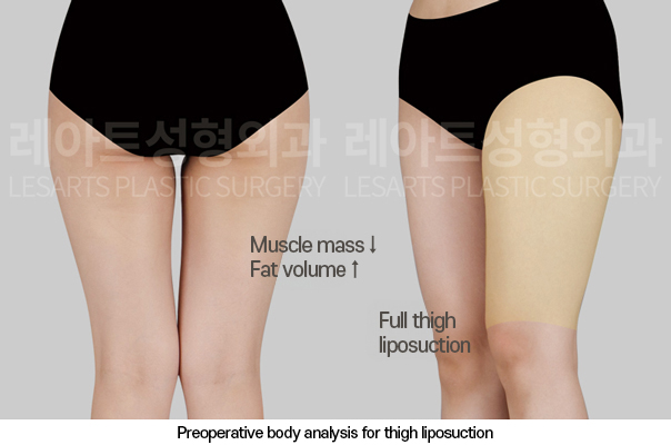thigh_liposuction_02_01_250325