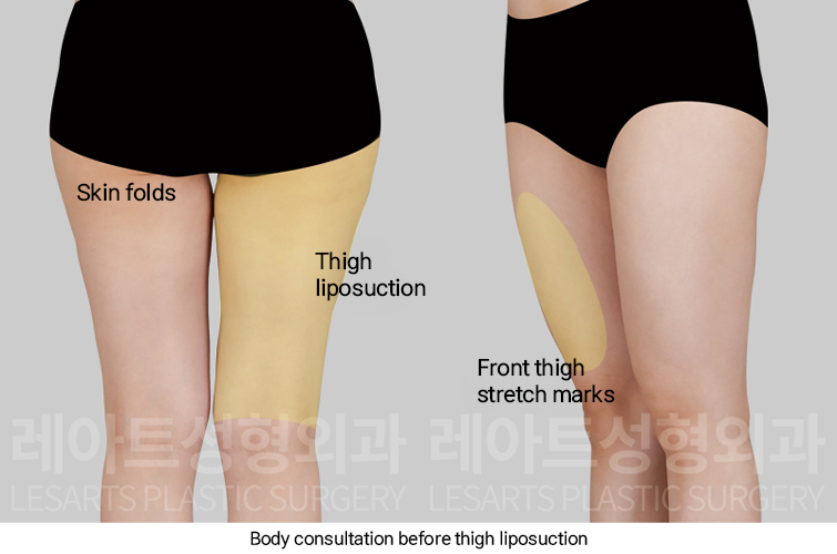 thigh_liposuction_02_02_250227