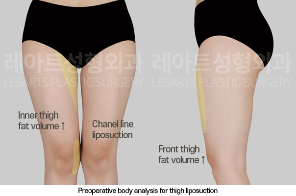 thigh_liposuction_02_02_250325