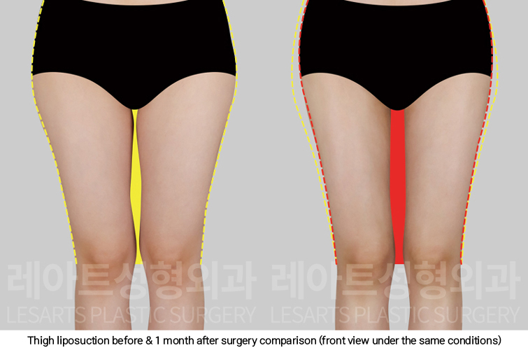 thigh_liposuction_02_03_250227
