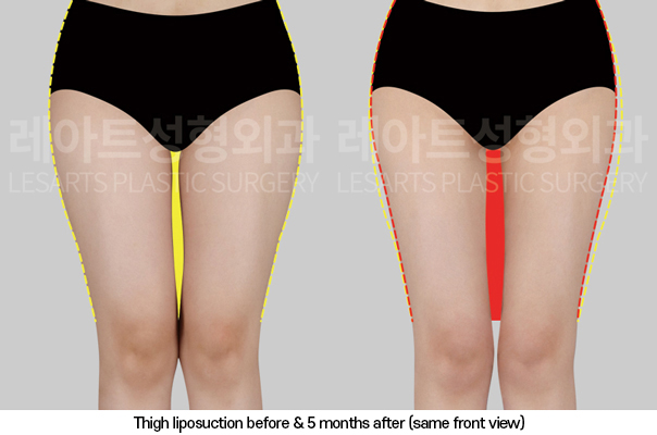 thigh_liposuction_02_03_250325