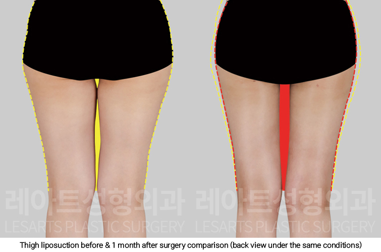 thigh_liposuction_02_04_250227