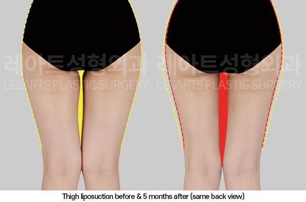 thigh_liposuction_02_04_250325