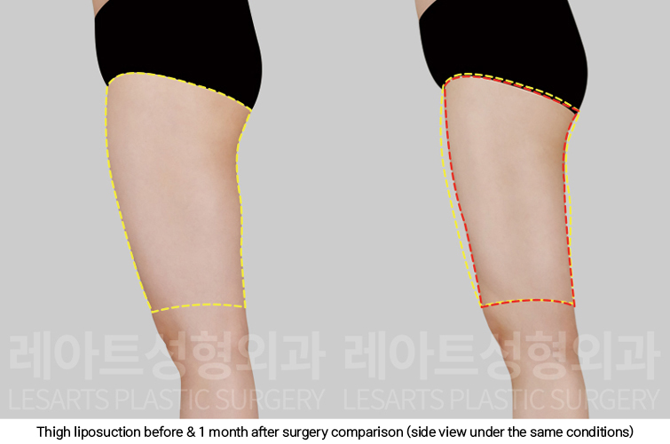 thigh_liposuction_02_05_250227