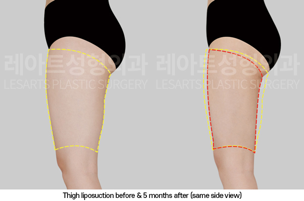 thigh_liposuction_02_05_250325
