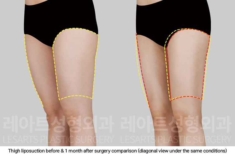 thigh_liposuction_02_06_250227