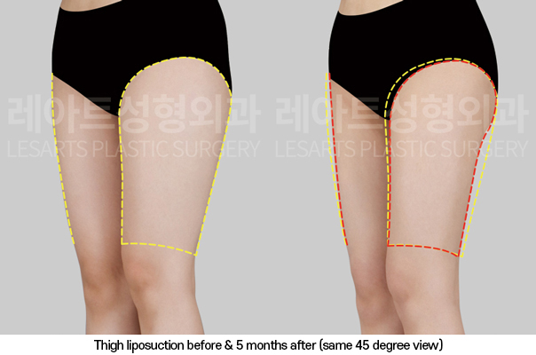 thigh_liposuction_02_06_250325