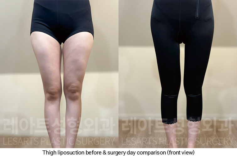 thigh_liposuction_02_07_250227