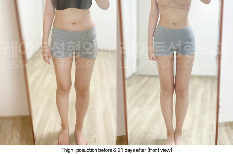 thigh_liposuction_02_07_250325