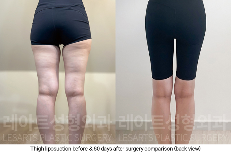 thigh_liposuction_02_08_250227