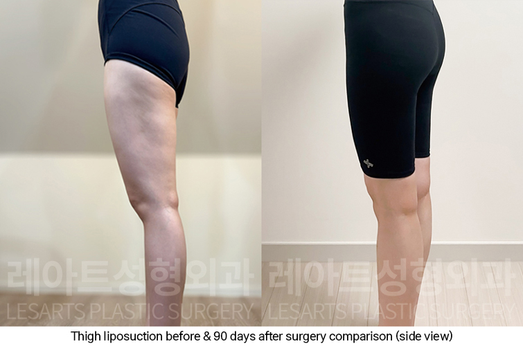 thigh_liposuction_02_09_250227