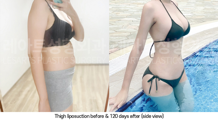 thigh_liposuction_02_09_250325