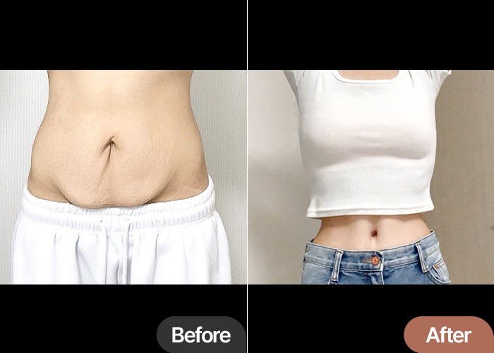 Before and after comparison of hehegnya’s tummy tuck at Lesarts Plastic Surgery in Korea, showing dramatic belly tightening.