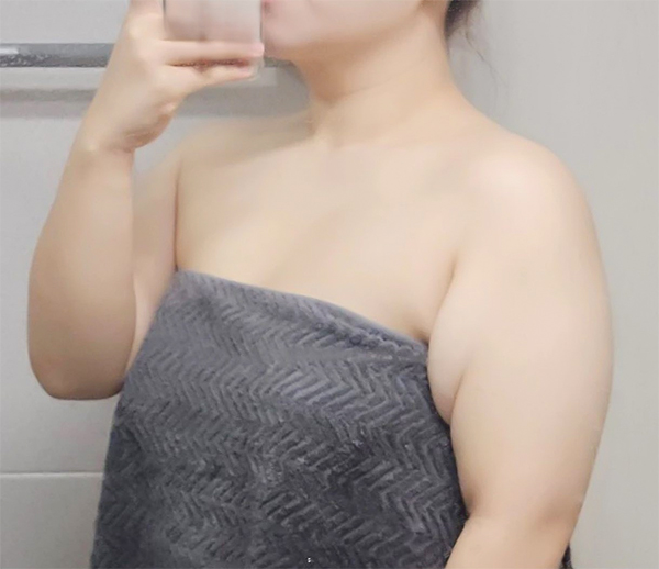 unniDOiTfz’s upper arm before arm liposuction at Lesarts Plastic Surgery in Korea.