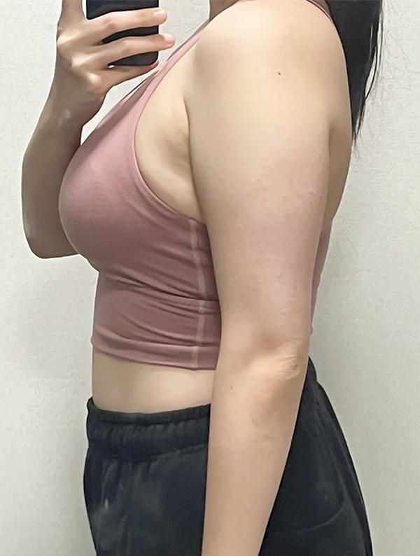unniWxeOIK before arm liposuction at Lesarts Plastic Surgery in Korea