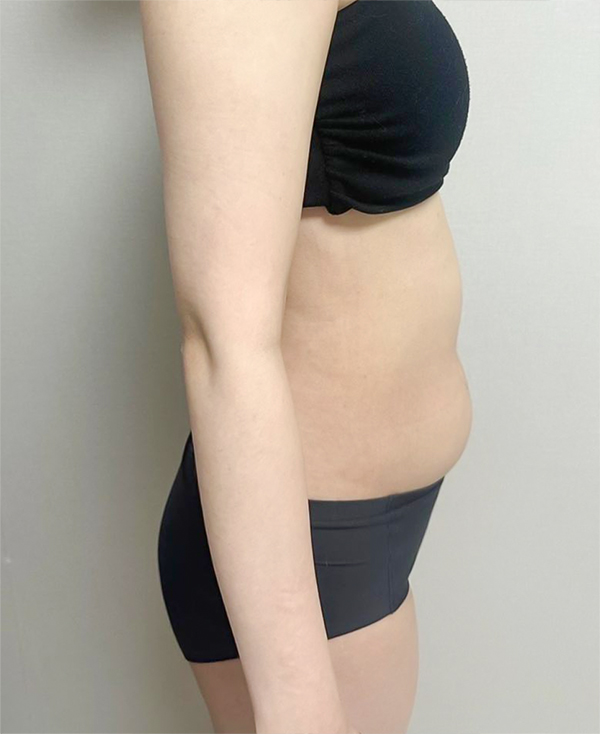 Side view before abdominal liposuction showing waist bulge in unniXGwrar at Lesarts Plastic Surgery in Korea.