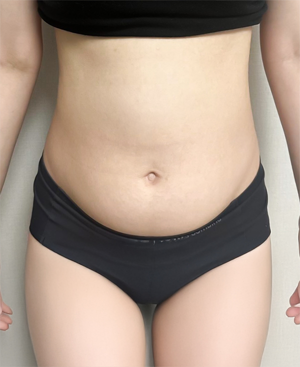 Before photo of unniXGwrar showing lower belly fat before abdominal liposuction at Lesarts Plastic Surgery in Korea.