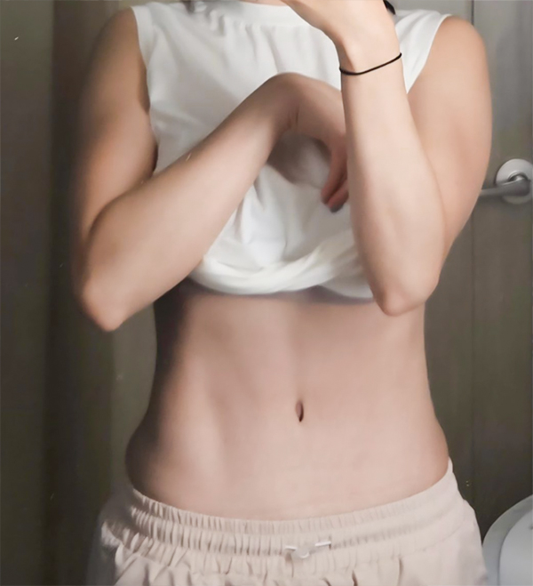 After tummy tuck result with flat, defined abs in front view.