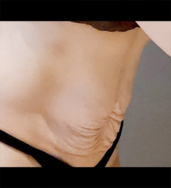 Before photo showing sagging abdominal skin from unniaoponx prior to tummy tuck at Lesarts.