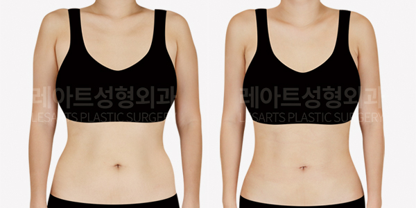 upper_body_liposuction_01_thumbnail_250225