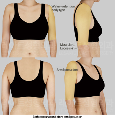 upper_body_liposuction_02_01_250225