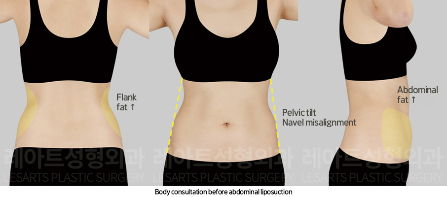 upper_body_liposuction_02_02_250225