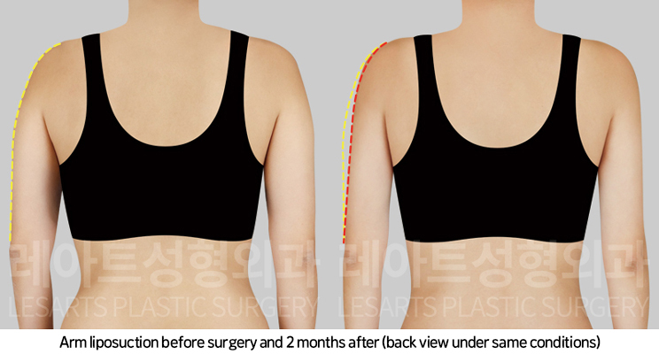 upper_body_liposuction_02_04_250225