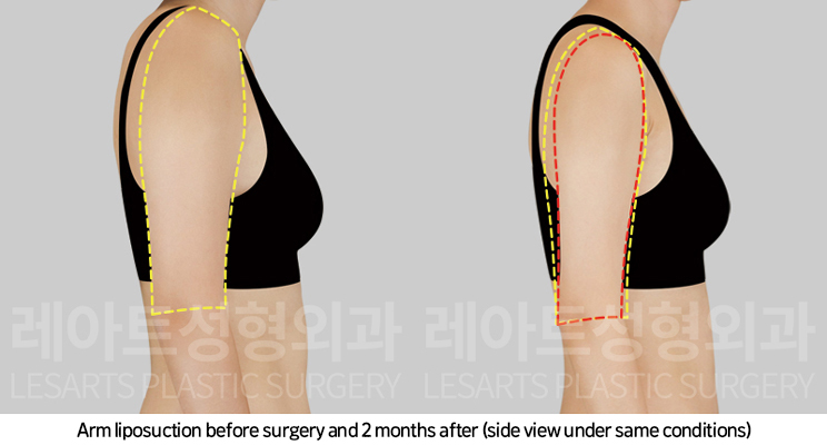upper_body_liposuction_02_05_250225