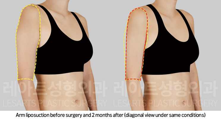 upper_body_liposuction_02_06_250225