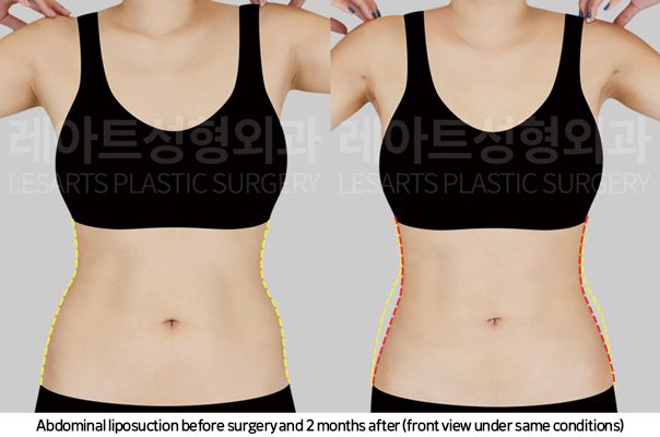 upper_body_liposuction_02_07_250225