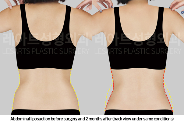 upper_body_liposuction_02_08_250225
