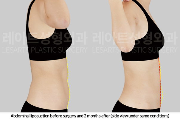 upper_body_liposuction_02_09_250225