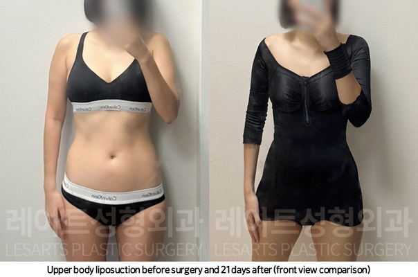 upper_body_liposuction_02_10_250225