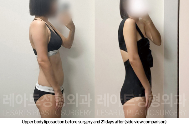 upper_body_liposuction_02_11_250225