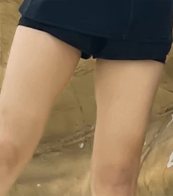vvv22's inner thigh fat before thigh liposuction at Lesarts Plastic Surgery in Korea