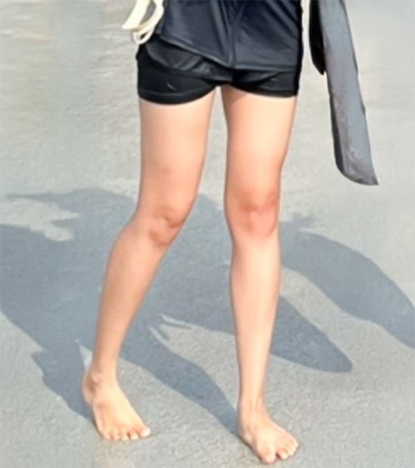 Preoperative photo showing vvv22’s thigh bulge before Korean liposuction procedure
