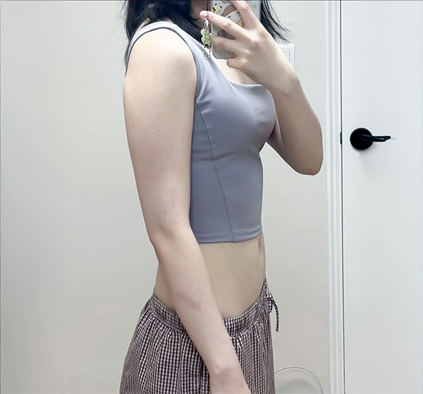 Before arm liposuction photo showing side profile of thick upper arm from yeonyeonyeonyeong at Lesarts Plastic Surgery in Korea.