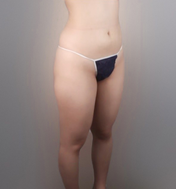 Thigh liposuction before photo in Korea – Lesarts Plastic Surgery Gangnam